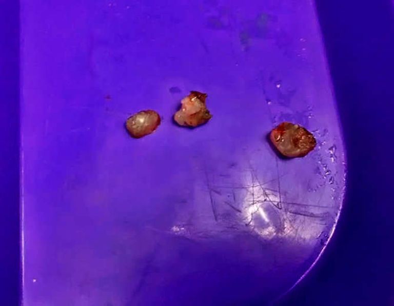 أطباء في الهند ينتزعون 7 أسنان من فم طفل في عمر شهر