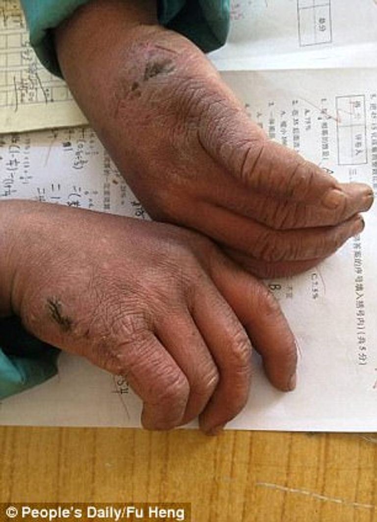 آثار الثلوج والبرد على يدي الطفل الطفل فومان يسير أكثر من ساعة يوميا في الطقس البارد