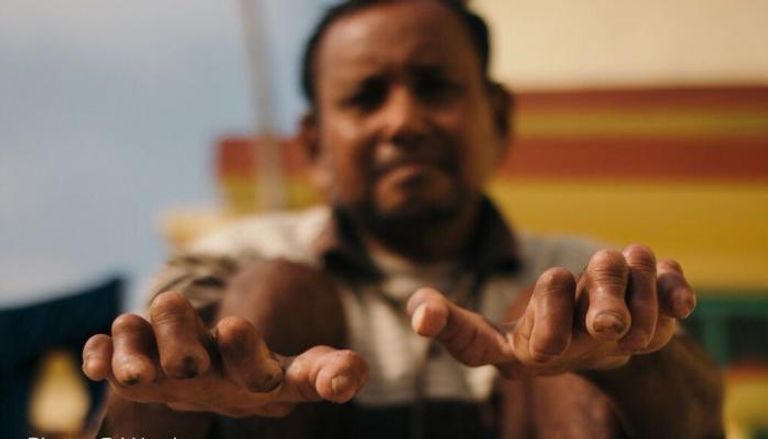 أحد مرضى الجذام المزمن - صورة من منظمة الصحة العالمية