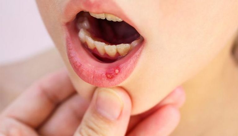 قرحة الفم من أعراض نقص فيتامين ب ١٢