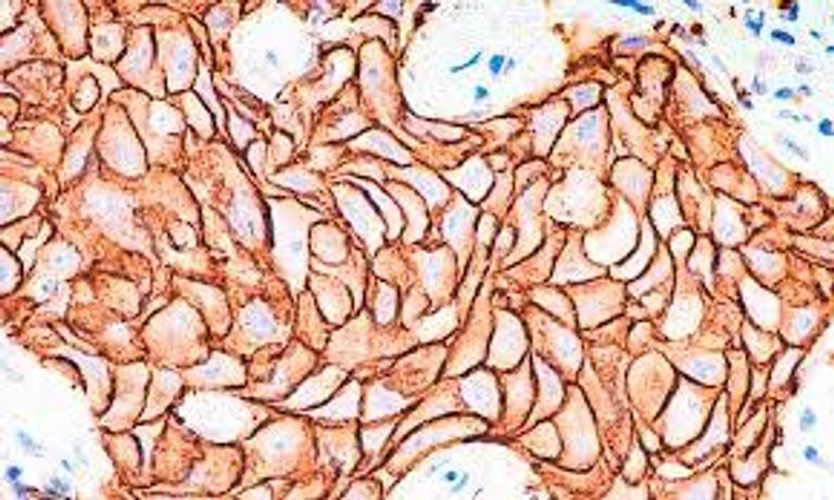 لقاح جديد يشفي من السرطانات في حالاتها المتأخرة