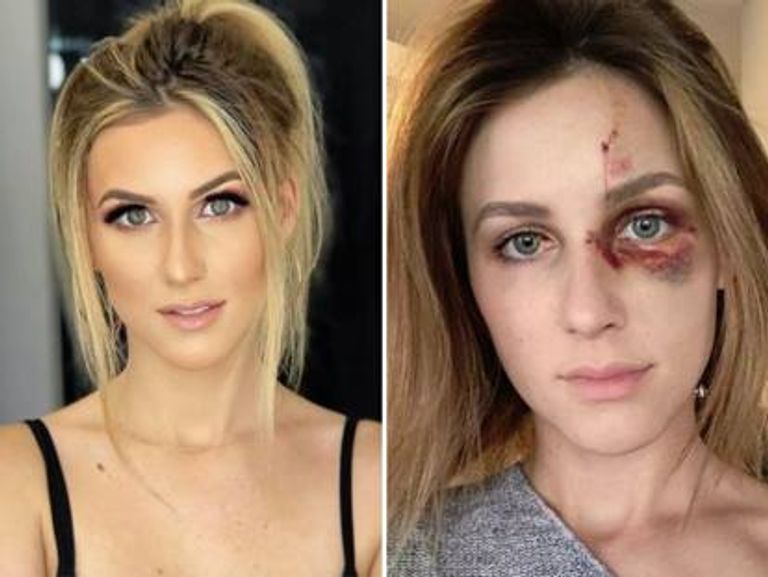 برازيلية تتعرض للضرب من خطيبها بسبب صورة على "أنستقرام"