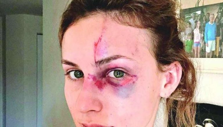 برازيلية تتعرض للضرب من خطيبها بسبب صورة على "أنستقرام"