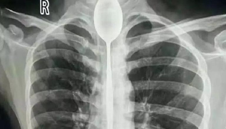 الملعقة تظهر في الأشعة قبل إجراء الجراحة للشاب الصيني 