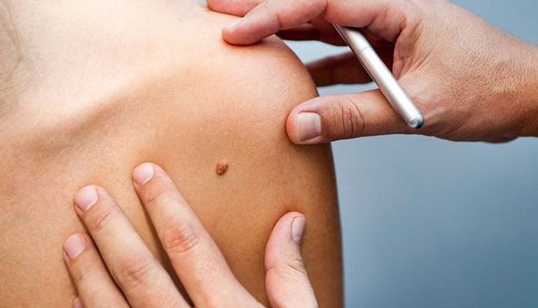 مضادات الأكسدة تسرع نمو وانتشار سرطان الجلد
