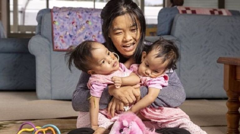 فصل توأم ملتصق بجراحة استمرت 6 ساعات في أستراليا