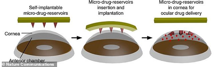 الإبر على اللاصقة المحملة بالدواء