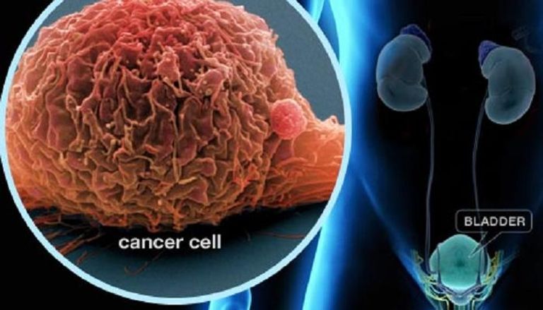 مجهر القوة الذرية يكشف خلايا سرطان المثانة