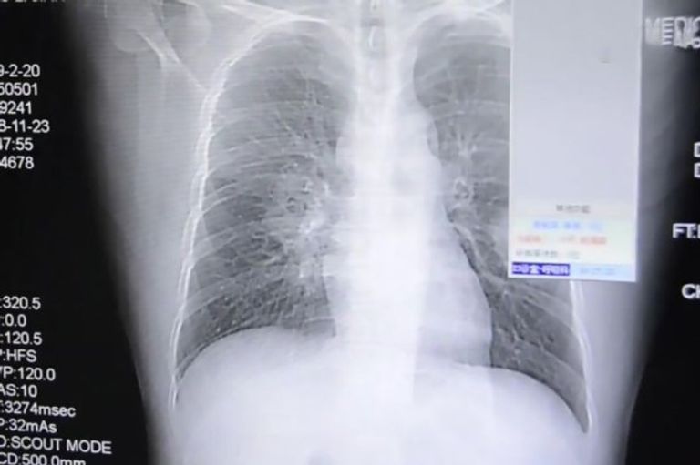 صيني يصاب بعدوى فطرية في الرئة بسبب عادته في استنشاق جواربه