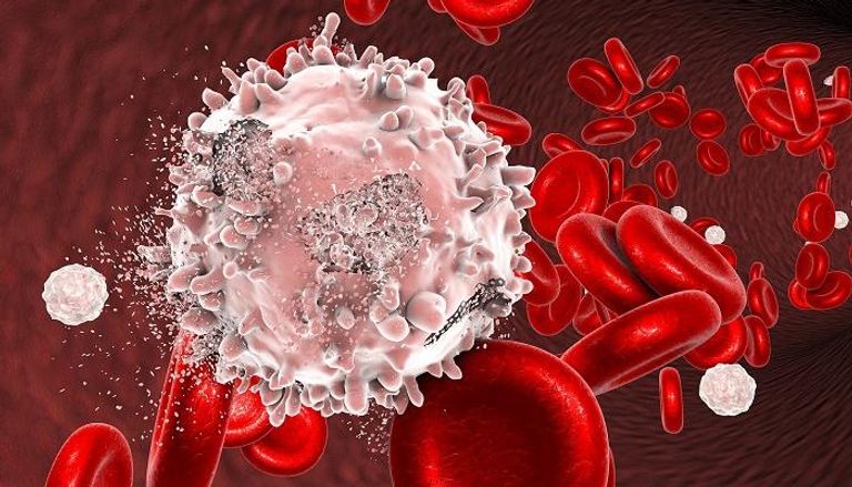 خلايا الدم البيضاء تطغى على الحمراء في مرض لوكيميا - أرشيفية