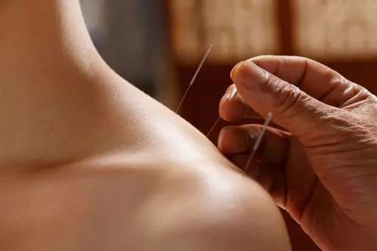 العلاج باستخدام الوخز بالإبر-أرشيفية 