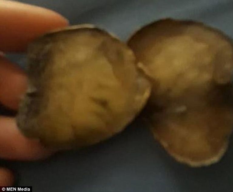 البطاطس بعد وضعها في جورب الطفلة الغرغرة بالماء المالح تخفف ألم احتقان الحلق