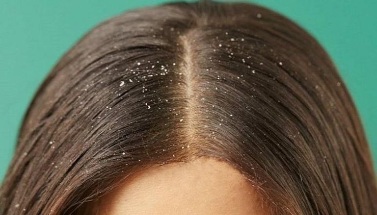 الزيوت المرطبة للفروة تساعد على محاربة قشرة الشعر