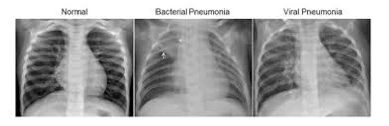 الروبوت يشخص الالتهابات الرئوية ويكشف عن مسبباتها