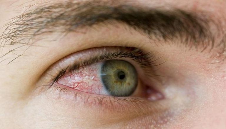 كثرة الإجهاد يعمل على احمرار العين 