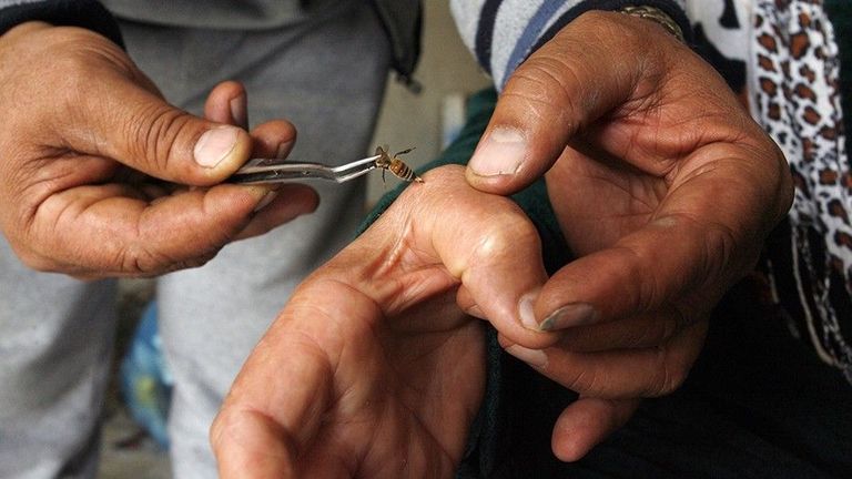طريقة العلاج بـ"وخز النحل"