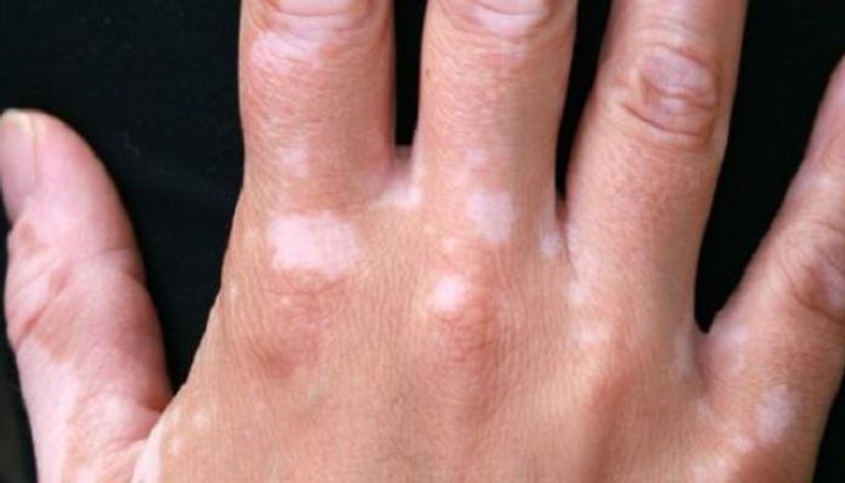 البهاق مرض جلدي غير معدٍ يسببه فقدان مادة الميلانين الصبغية في الجلد