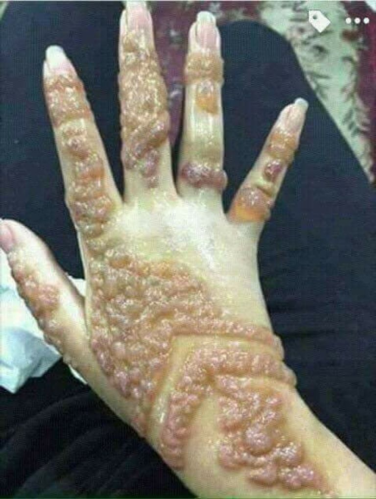 آثار الحنة القاتلة الجزائر تحذر من حناء قاتلة قادمة من ليبيا