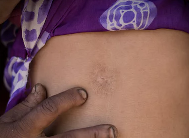 التوسيم بقطعة ساخنة من الحديد أو القماش