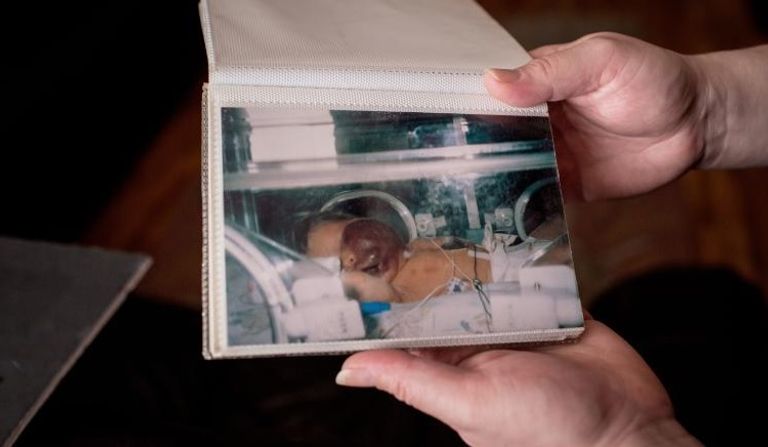 مراهق يفقد ضحكته بسبب ورم نادر