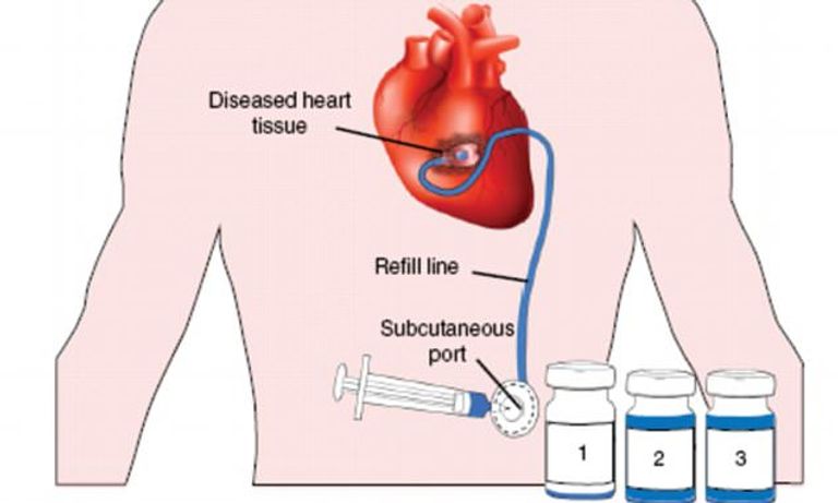 جهاز جديد ينقذ حياة الملايين من مرضى القلب