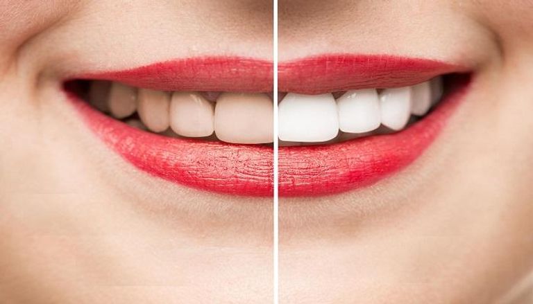 4 خطوات للحصول على أسنان بيضاء بشكل دائم