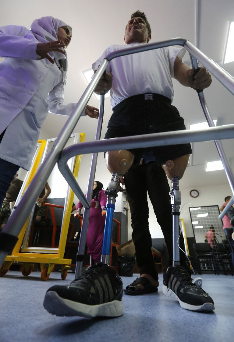 تركيب الأطراف صناعة تطورت في سوريا خلال الحرب 