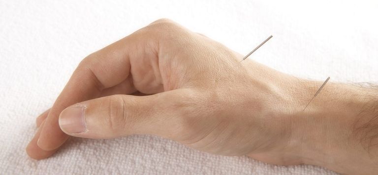 الإبر الصينية أثبتت فاعلية كبيرة في العلاج