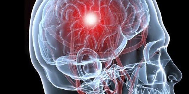 السكتة الدماغية تؤدي إلي الإصابة بالصداع المفاجئ