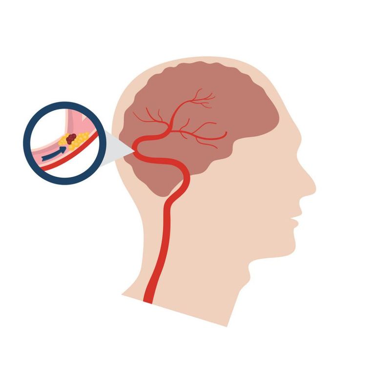 السكتة الدماغية تؤدي إلي الإصابة بالصداع المفاجئ