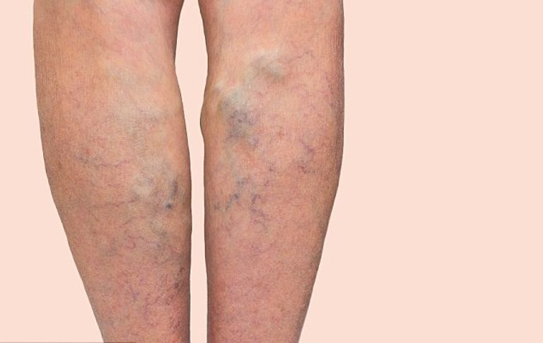 مصباح يعالج القرح والدوالي