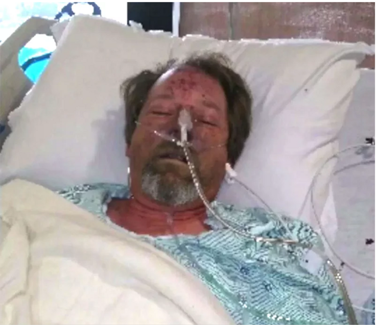 أمريكي يتعرض لبتر أطرافه الأربعة بعد لعقة كلب