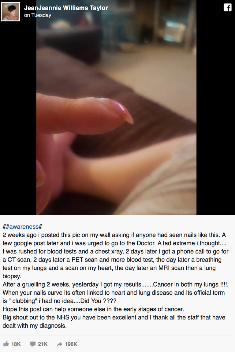 شكل الأظافر قد يدل على الإصابة بسرطان الرئة