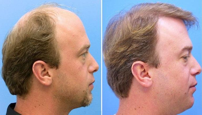 مراحل نمو الشعر بعد عملية زراعة الشعر