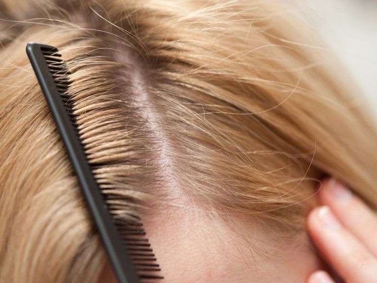 صارم تعليم الخراب  تخلصي من قشرة الشعر بـ5 وصفات طبيعية