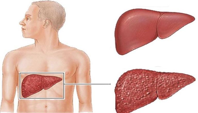 التهاب الكبد الوبائي قد يؤدي للوفاة