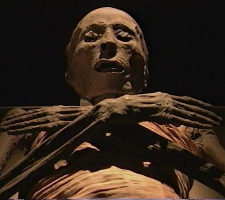 المسمار الطبي معروف منذ الفراعنة