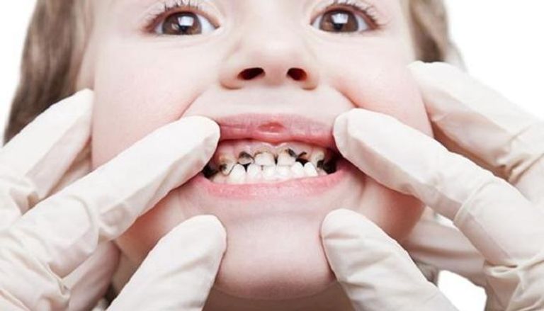الوقاية من تسوس أسنان الأطفال خير من العلاج 
