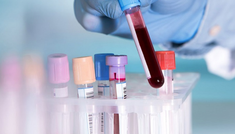 اختبار دم يساعد في تحديد العلاج المناسب لسرطان الرئة - أرشيفية