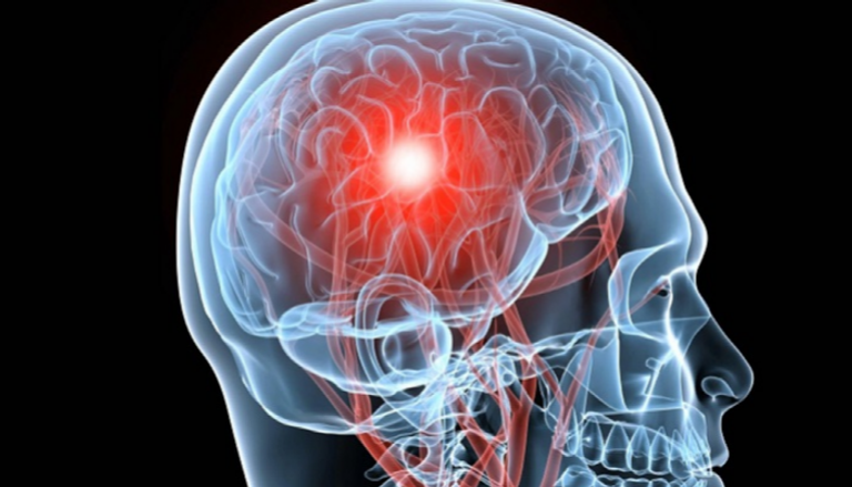 إصابات الدماغ المؤلمة قد تدمر الخلايا العصبية