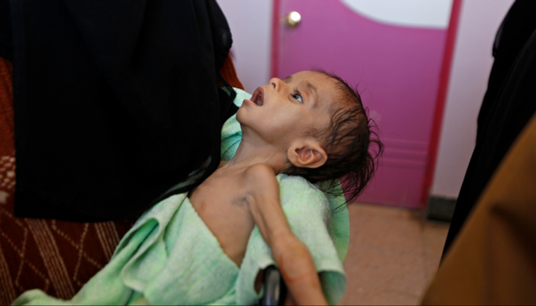 مليونا طفل في اليمن يعانون من سوء التغذية الحاد