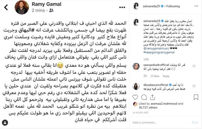 المطرب المصري رامي جمال يعلن إصابته بالبهاق