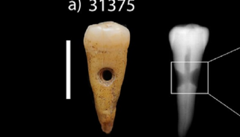 الأسنان كانت مادة أساسية في زينة انسان العصر الحجري الحديث
