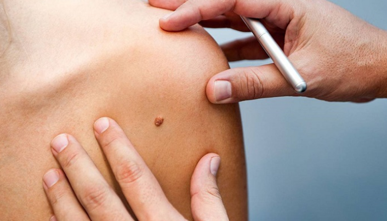 ظهور الشامات قد يشير إلى الإصابة بسرطان الجلد
