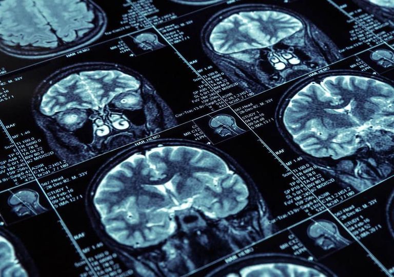 السمنة وعلاقتها بالخرف