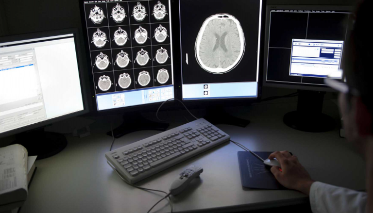 قفاز لعلاج تبعات السكتة الدماغية