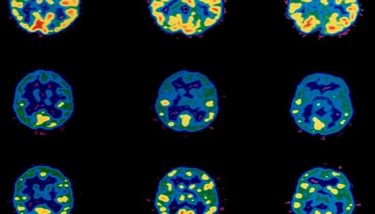 تصوير الدماغ يساعد في اكتشاف أمراض الأطفال العقلية مبكرا