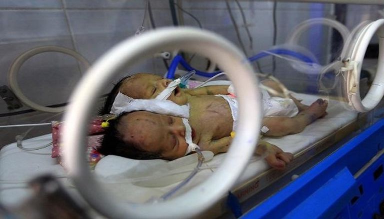 التوأمان السياميان اليمنيان في حاضنة بمستشفى قرب العاصمة اليمنية