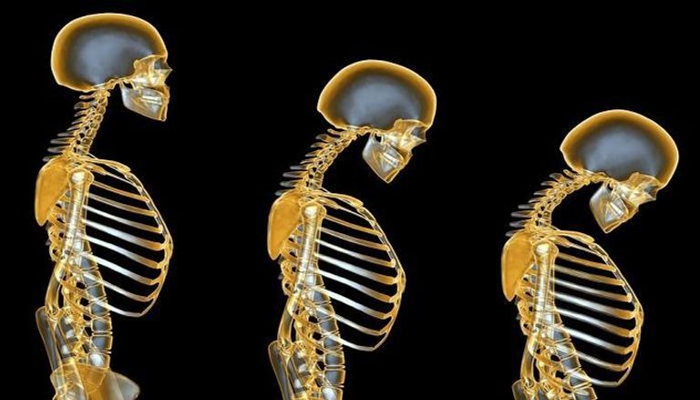 اكتشاف تقنية جديدة لإصلاح تشوهات العظام المعقدة - صورة أرشيفية