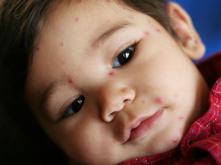 أنواع وأسباب حبوب الجلد لدى الأطفال وطرق الوقاية منها